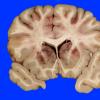 2A4 Infarcts, watershed, Seizures (Case 2)_6