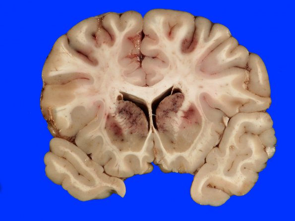 2A4 Infarcts, watershed, Seizures (Case 2)_6