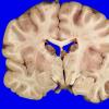 2A5 Infarcts, watershed, Seizures (Case 2)_8