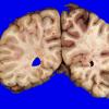 2A6 Infarcts, watershed, Seizures (Case 2)_11