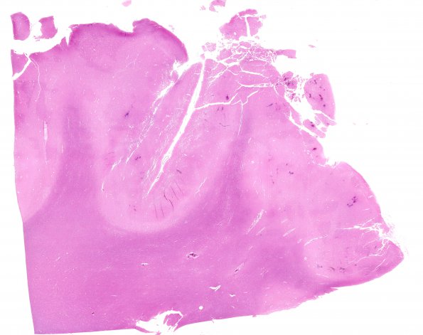 2B1 Infarcts, watershed, Seizures (Case 2) N13 H&E WM