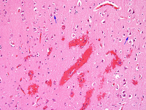 2B3 Infarcts, watershed, Seizures (Case 2) N12 H&E 2