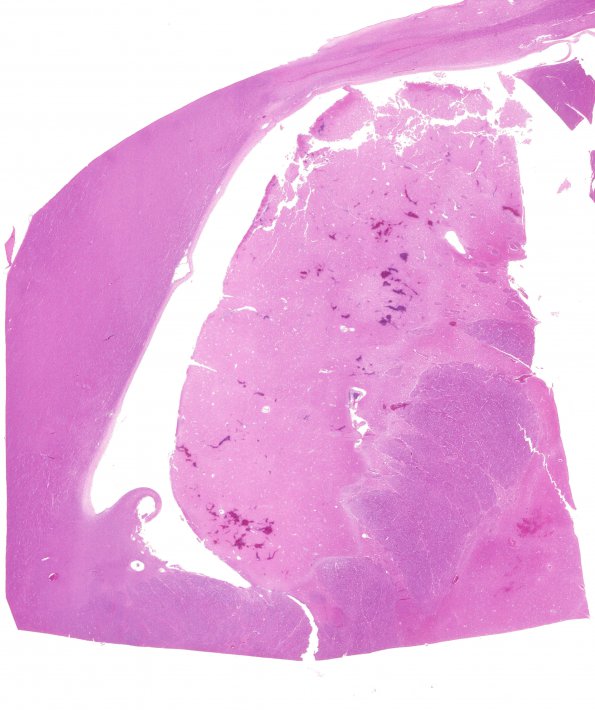 2B4 Infarcts, watershed, Seizures (Case 2) N2 H&E 1