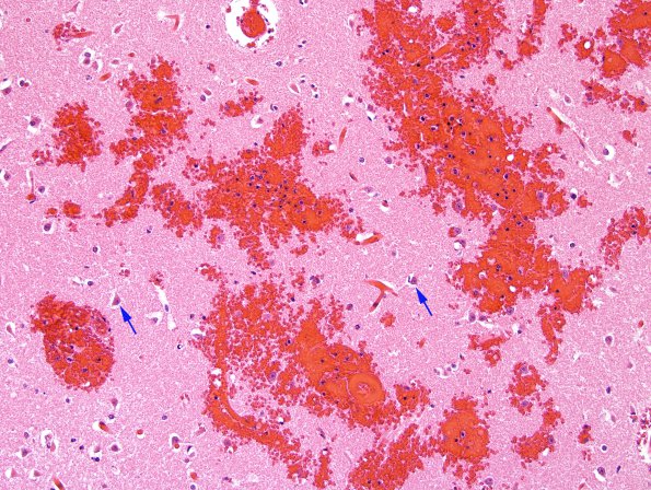 2B5 Infarcts, watershed, Seizures (Case 2) N2 H&E 2 copy