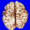 3A1 Infarct, neonatal, watershed (Case 3)_5 copy