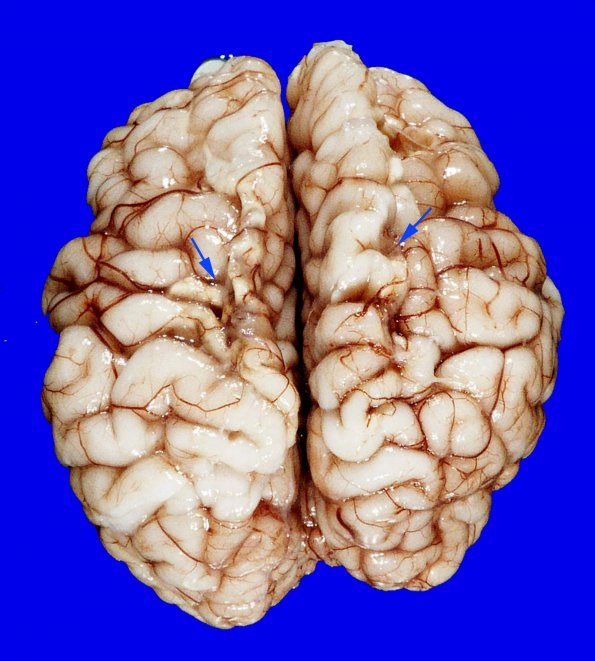 3A1 Infarct, neonatal, watershed (Case 3)_5 copy