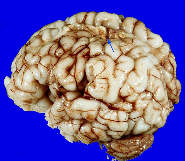 3A2 Infarct, neonatal, watershed (Case 3)_6 copy