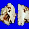 3A3 Infarct, neonatal, watershed (Case 3)_9