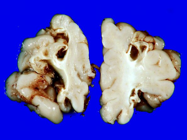 3A3 Infarct, neonatal, watershed (Case 3)_9