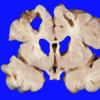 3A4 Infarct, neonatal, watershed (Case 3)1-A