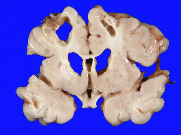 3A4 Infarct, neonatal, watershed (Case 3)1-A