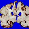 3A5 Infarct, neonatal, watershed (Case 3)_12 A