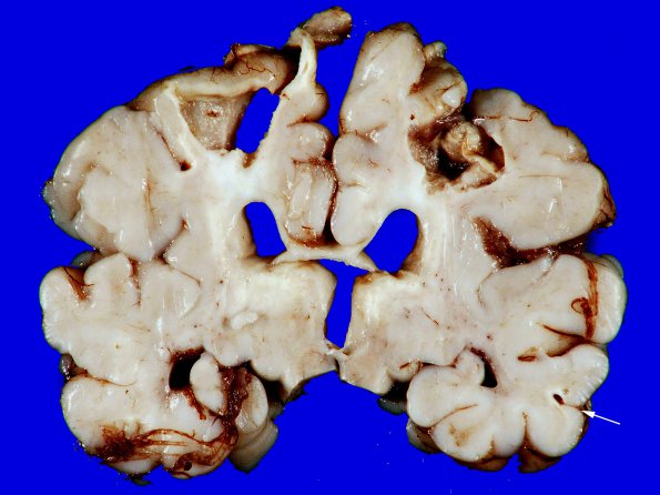 3A5 Infarct, neonatal, watershed (Case 3)_12 A