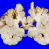 3A6 Infarct, neonatal, watershed (Case 3)_16