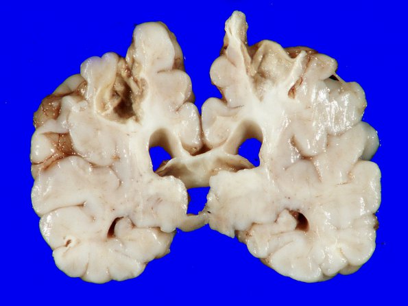 3A6 Infarct, neonatal, watershed (Case 3)_16