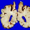 3A7 Infarct, neonatal, watershed (Case 3)_13