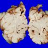 3A8 Infarct, neonatal, watershed (Case 3)_14