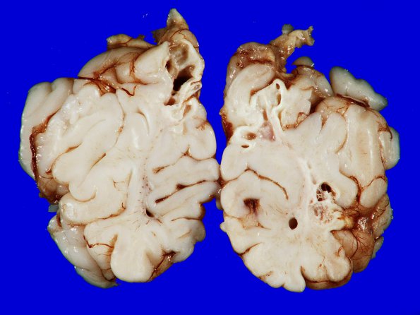 3A8 Infarct, neonatal, watershed (Case 3)_14