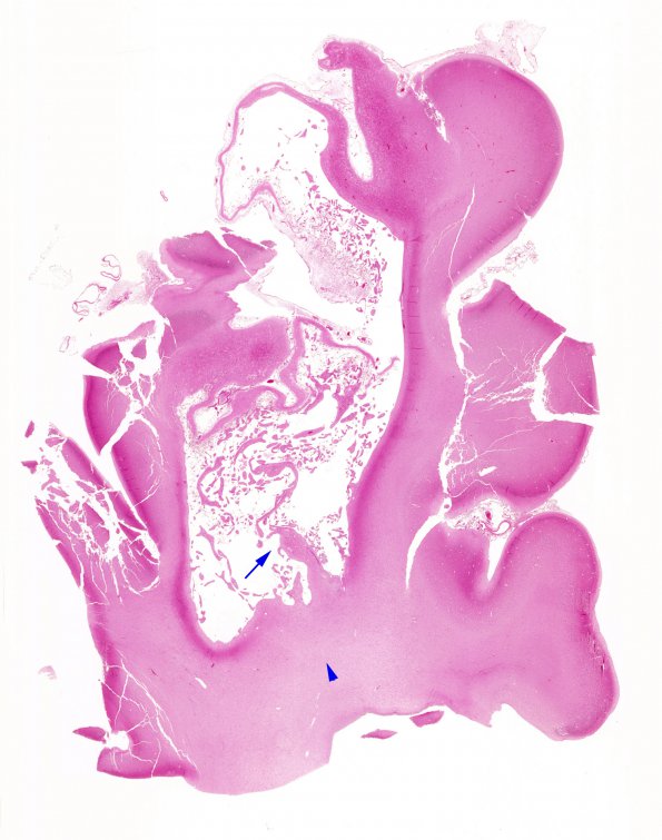 3B1 Infarct, neonatal, watershed (Case 3) N1 H&E  A series 1