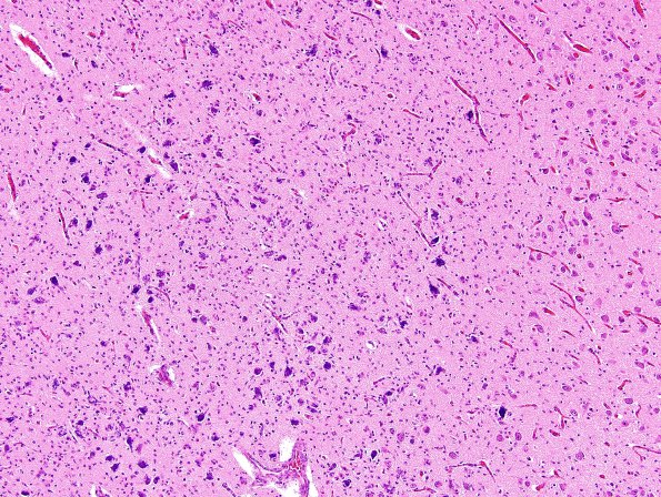 3B10 Infarct, neonatal, watershed (Case 3) H&E 2