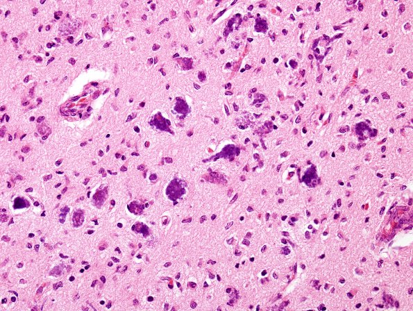 3B11 Infarct, neonatal, watershed (Case 3) N4 H&E 1