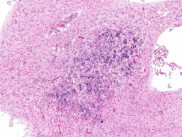 3B12 Infarct, neonatal, watershed (Case 3) N11 H&E 2