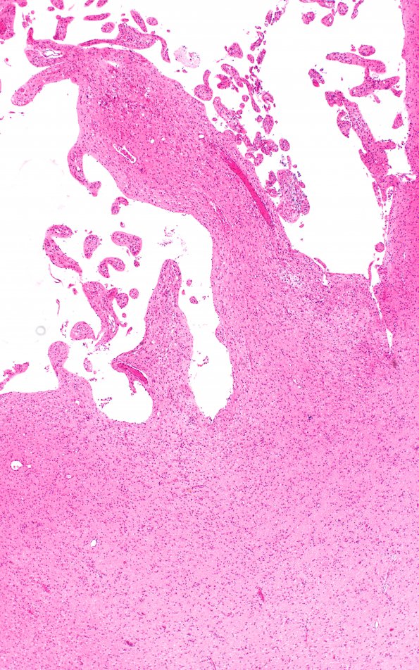 3B2 Infarct, neonatal, watershed (Case 3) N1 H&E  A series 4X