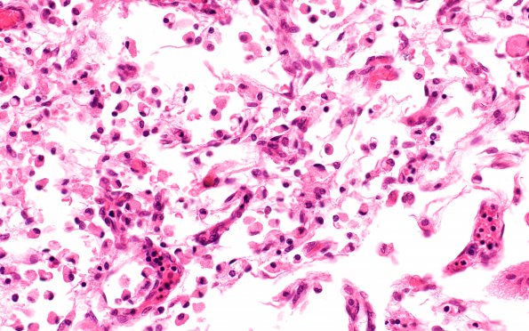 3B3 Infarct, neonatal, watershed (Case 3) N1 H&E  A series 40X 2