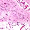 3B4 Infarct, neonatal, watershed (Case 3) N1 H&E 3