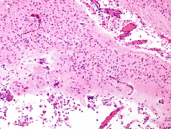 3B4 Infarct, neonatal, watershed (Case 3) N1 H&E 3