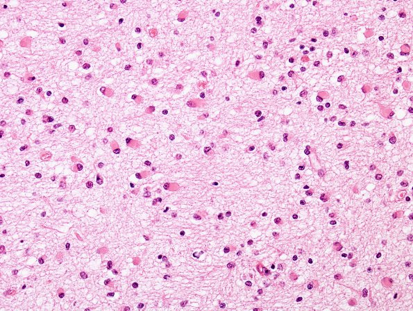 3B5 Infarct, neonatal, watershed (Case 3) N1 H&E 7 White matter