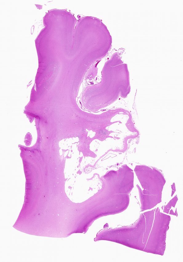 3B6 Infarct, neonatal, watershed (Case 3) H&E WM