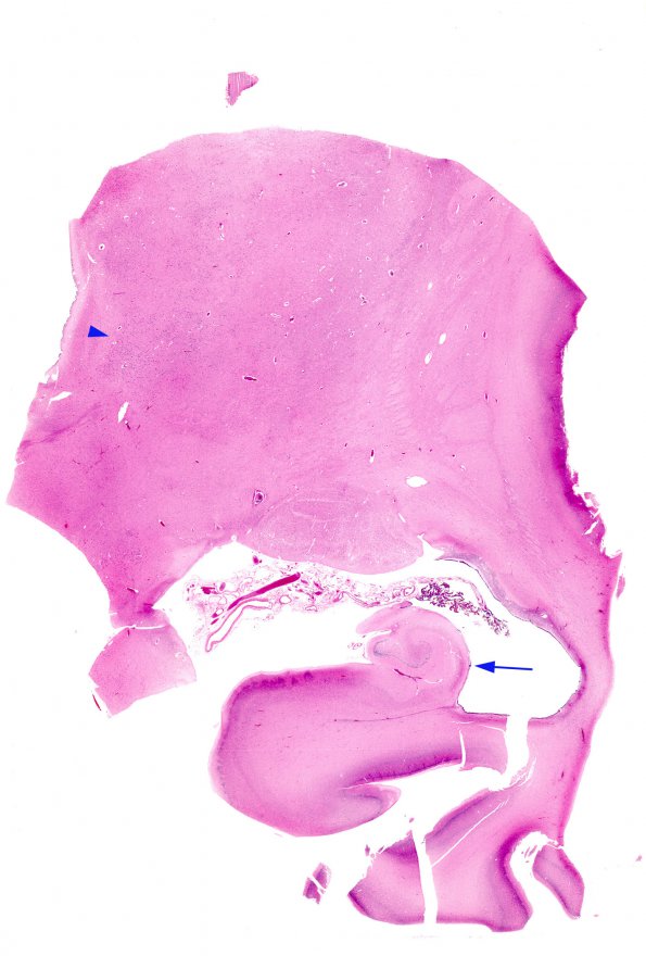 3B7 Infarct, neonatal, watershed (Case 3) N4 1 H&E WM