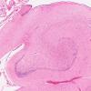 3B8 Infarct, neonatal, watershed (Case 3) N3 H&E 4X