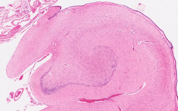 3B8 Infarct, neonatal, watershed (Case 3) N3 H&E 4X