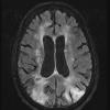 4A1 Infarct watershed (Case 4) FLAIR 2 - Copy