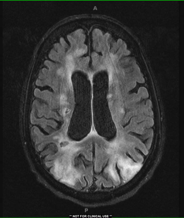 4A1 Infarct watershed (Case 4) FLAIR 2 - Copy