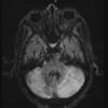 4A2 Infarct watershed (Case 4) FLAIR 4 - Copy