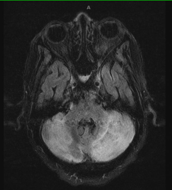 4A2 Infarct watershed (Case 4) FLAIR 4 - Copy