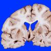 4B1 Infarct, Watershed (Case 4) 7