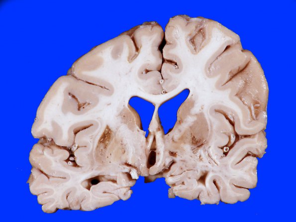 4B1 Infarct, Watershed (Case 4) 7