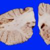 4B10 Infarct, Watershed (Case 4) 25