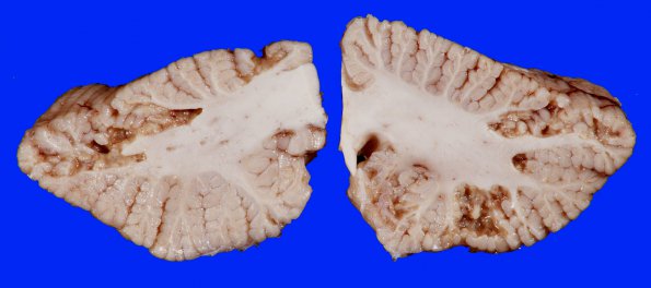 4B10 Infarct, Watershed (Case 4) 25