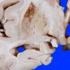 4B2 Infarct, Watershed (Case 4) 8