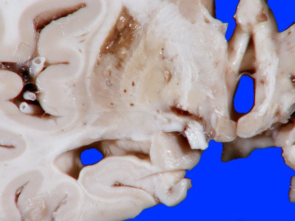 4B2 Infarct, Watershed (Case 4) 8