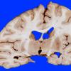 4B3 Infarct, Watershed (Case 4) 10