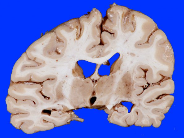 4B3 Infarct, Watershed (Case 4) 10