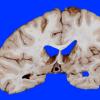 4B5 Infarct, Watershed (Case 4) 12