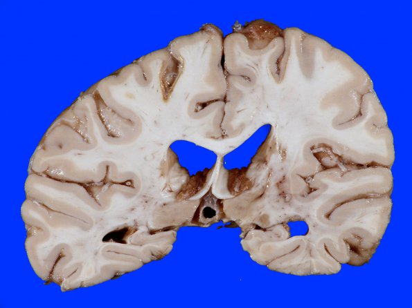 4B5 Infarct, Watershed (Case 4) 12