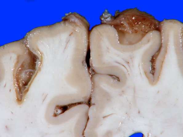 4B6 Infarct, Watershed (Case 4) 13